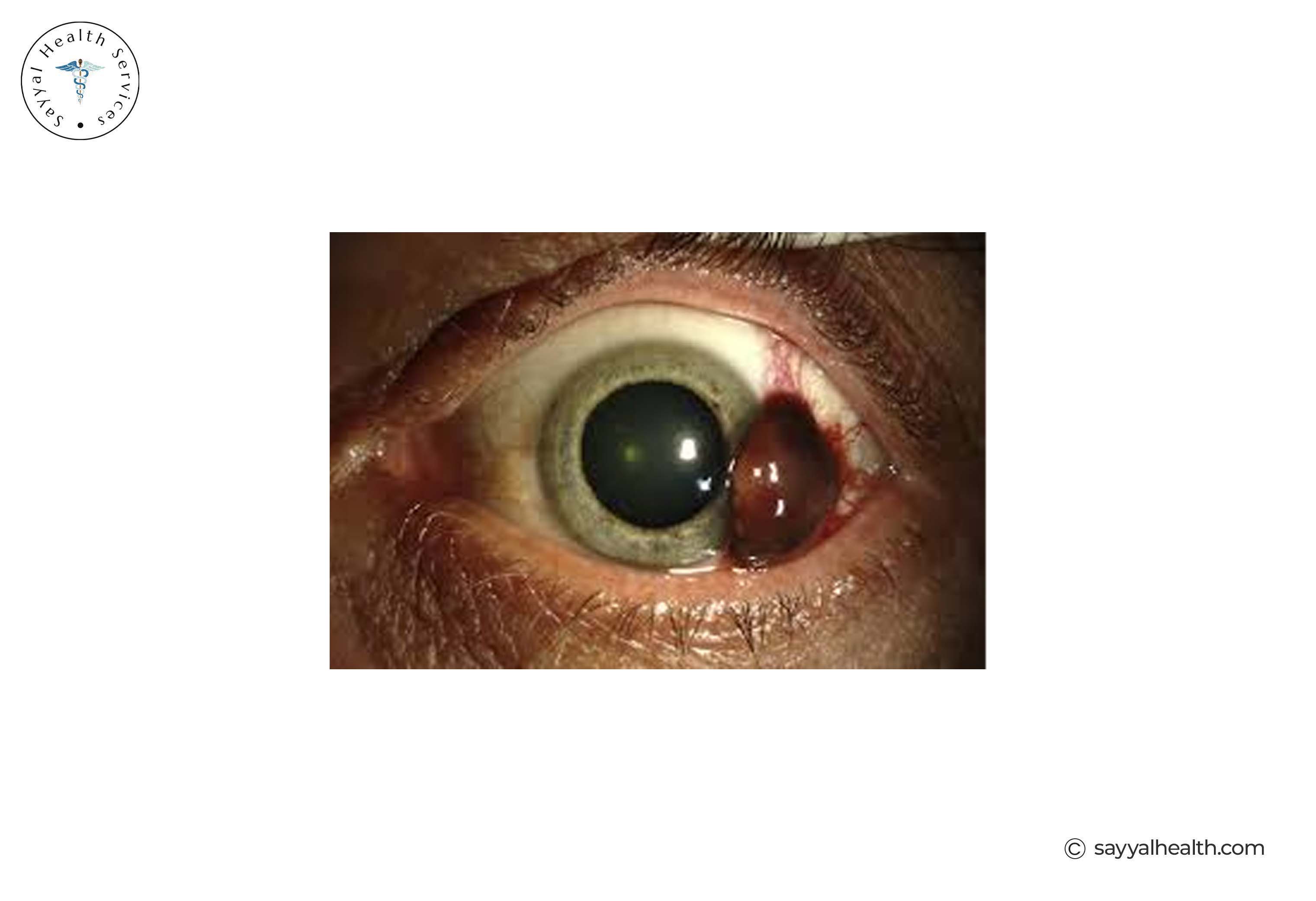 picture of ocular melanoma